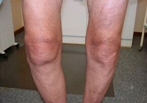 How to treat knee arthrosis