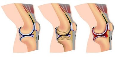 Stages of the development of knee joint arthrosis