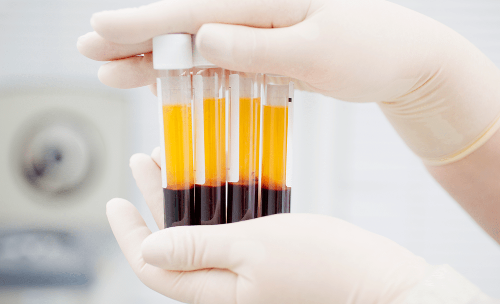 Platelet-enriched plasma for PRP therapy of arthrosis